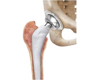 Prótesis rodeada de cemento con antibiótico
