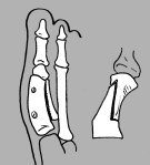 Detalle de osteotomia de Scarf