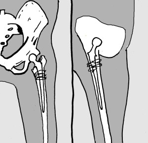 Reprótesis de cadera