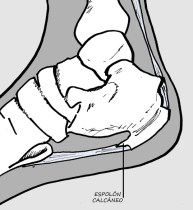Espolón calcáneo