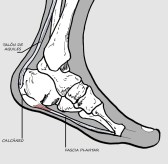 Fascitis plantar