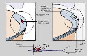 Menisco 06_Sutura