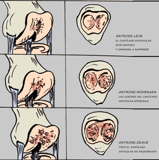 artrosis evolución 2